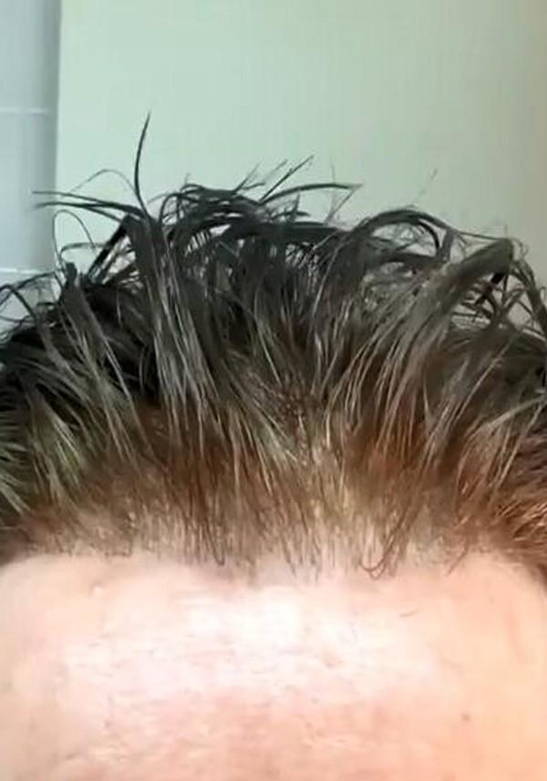 vordere Haarlinie - Skin Haarsystem für Männer