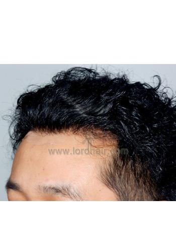 l12 hair replacement system