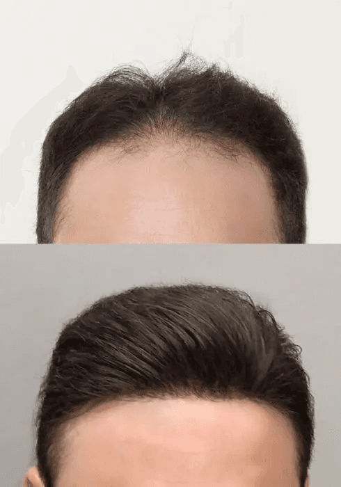 Lace Frontal Maßanfertigung Lordhair