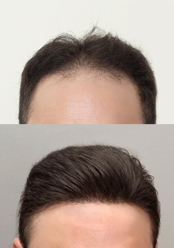 SuersSkin-FMaßanfertigung frontales Haarsystem für zurückweichende Haarlinie Männer 