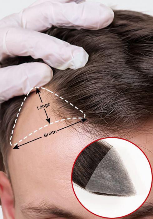 Angepasstes Haar Pflaster für Geheimratsecken Lordhair