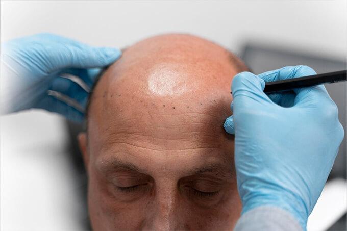 Der Aufstieg biotechnologisch hergestellter Haarsysteme
