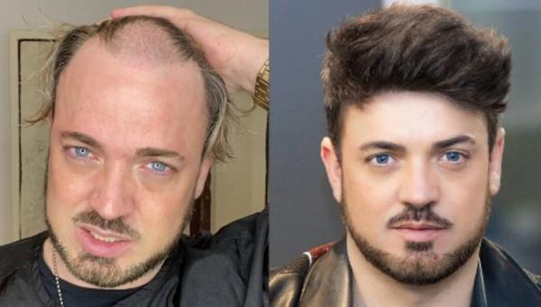 Geheimratsecken kaschieren