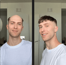 Wann brauche ich ein neues Haarsystem? – So erkennst du, dass es Zeit für einen Austausch ist