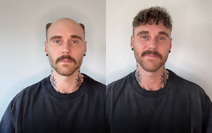 Lordhair Haarsystem – Vorher und Nachher