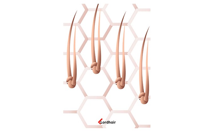 single-split knoten (geteilter einzelknoten)