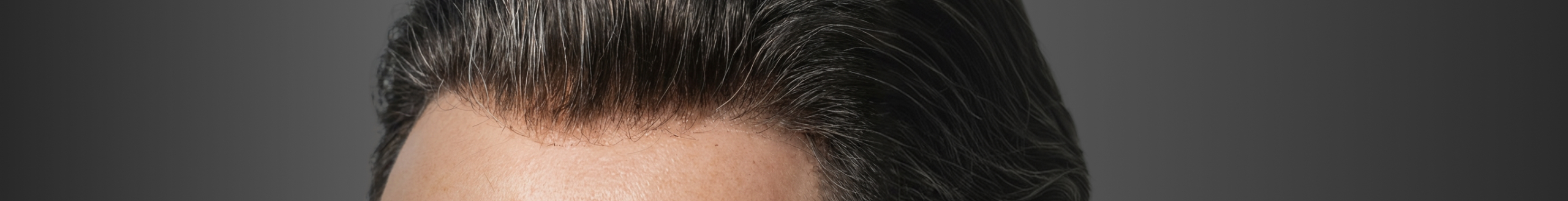 Haarsysteme mit geringer Dichte