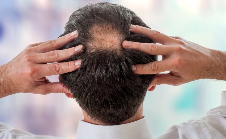 Mittel und Behandlungen bei Kreisrundem Haarausfall