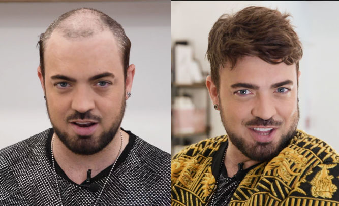 Aaron mit Haarsystem