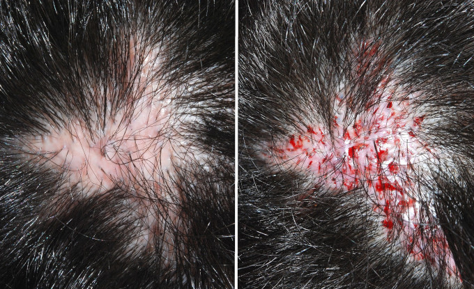 Haartransplantation vs. Haarsystem