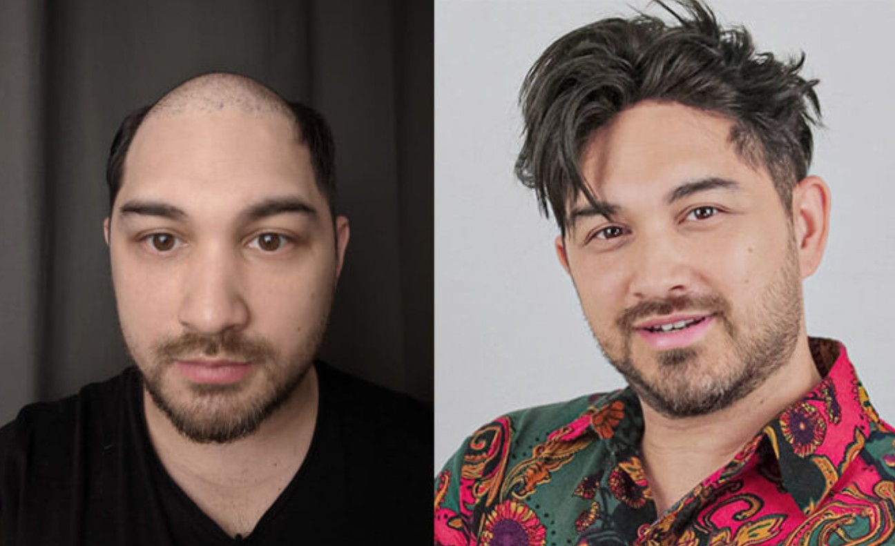 Kundenfoto vorher nachher toupet