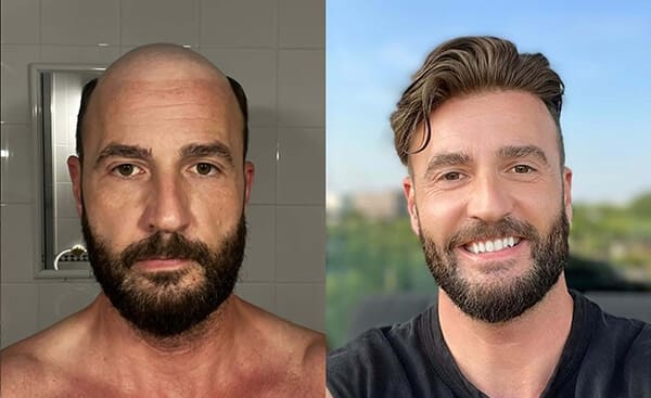 vorher-nachher mit Toupet