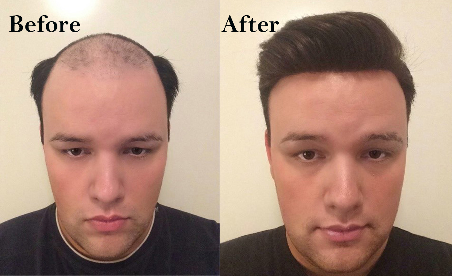 non surgical hair replacement systems before & after