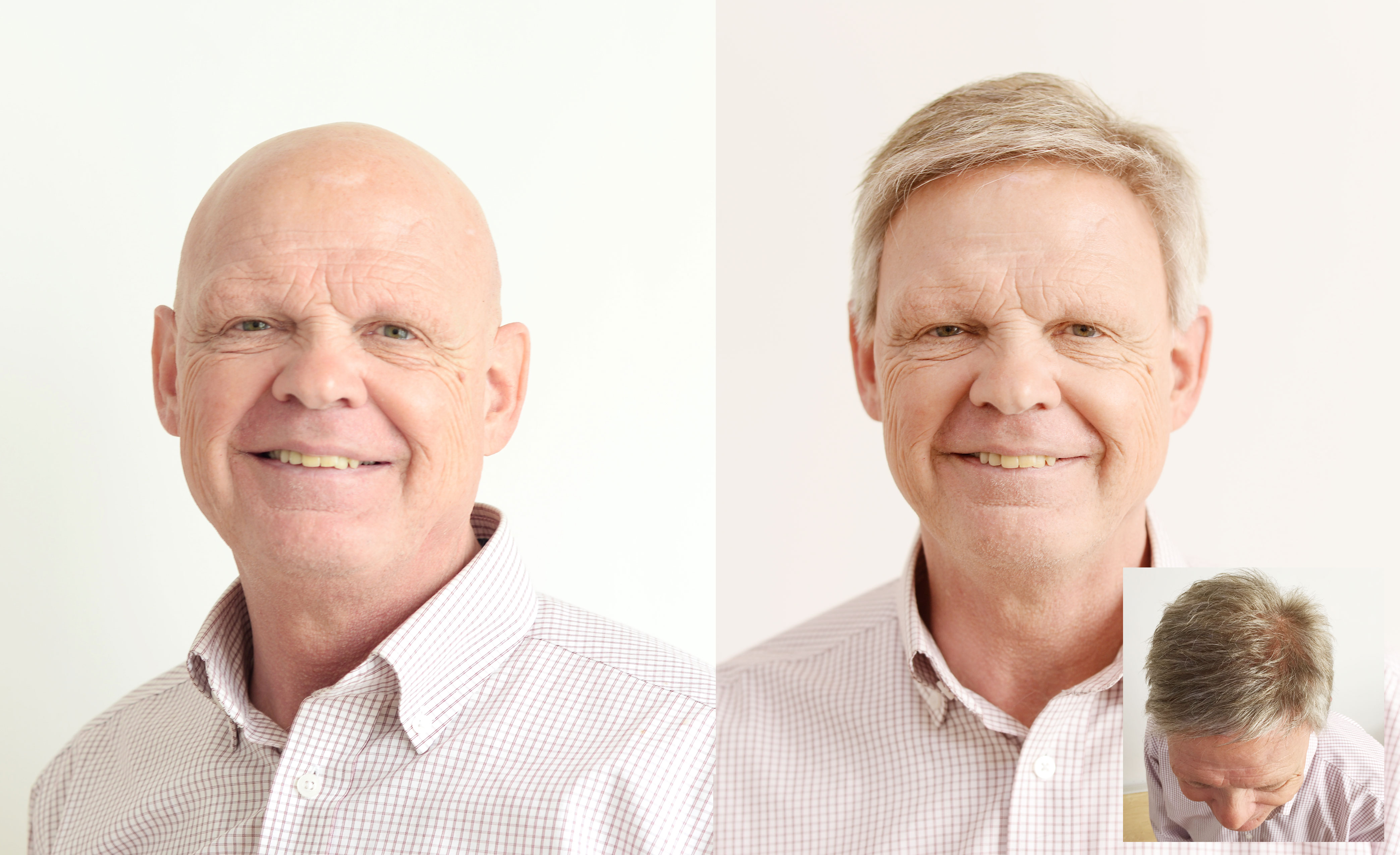 non surgical hair replacement systems before & after - Gary