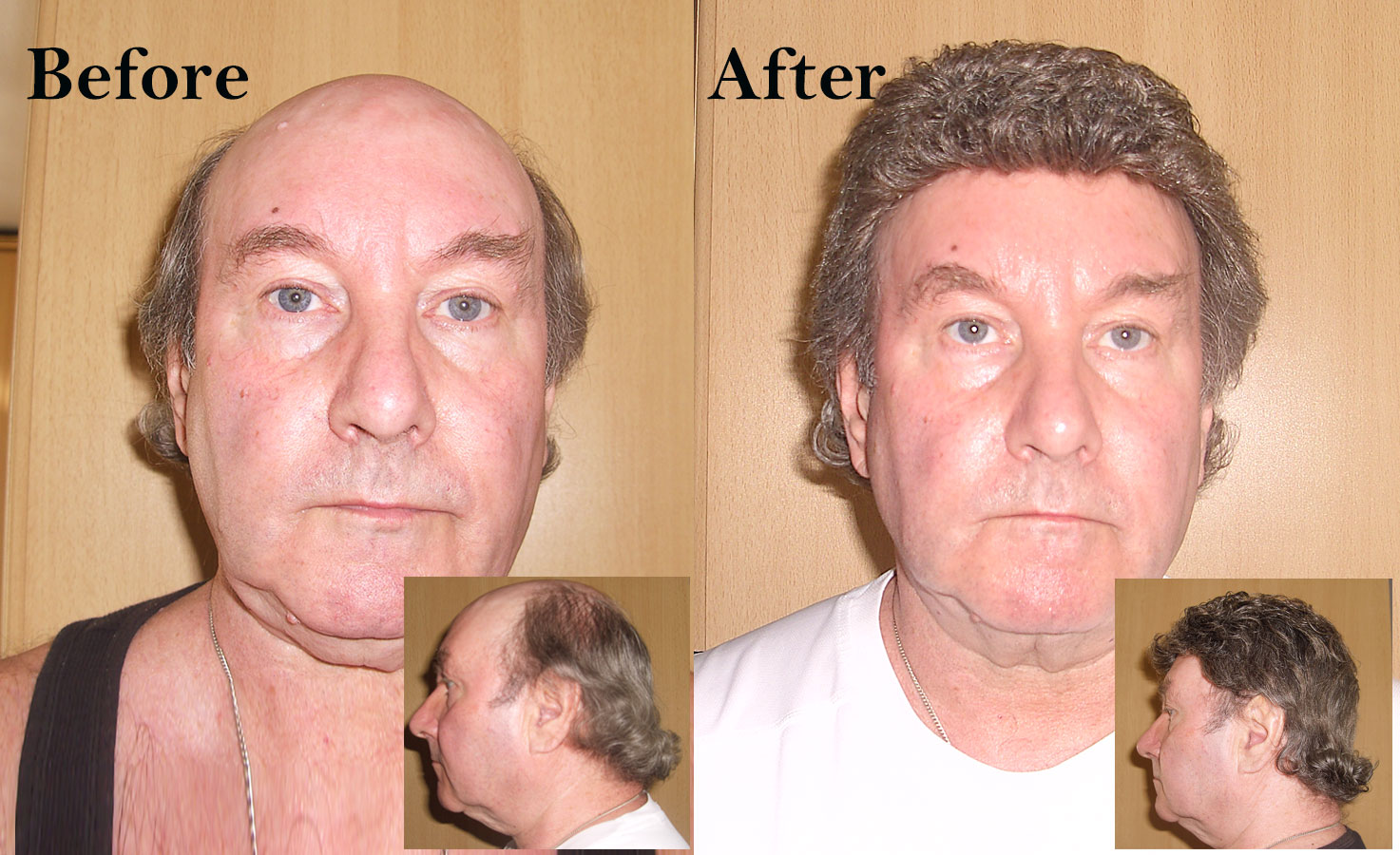 Non Surgical Hair Replacement System Photo