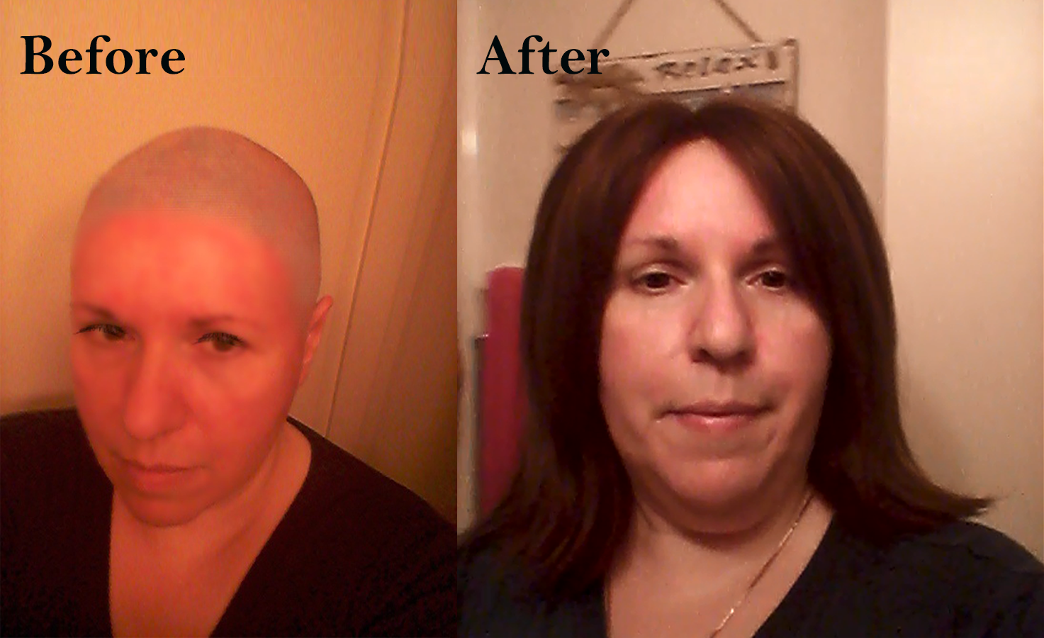 Female hair replacement before & after